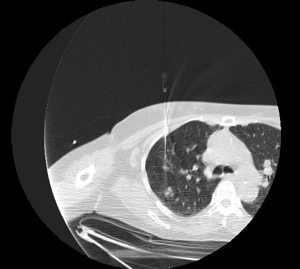 Iatrogenic pulmonary hemorrhage from lung biopsy Patient#3 Image courtesy of RadsWiki and copylefted