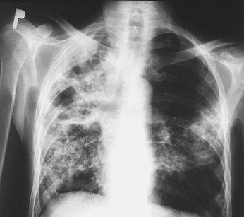 File:Pulmonary Tuberculosis X-ray2.jpg