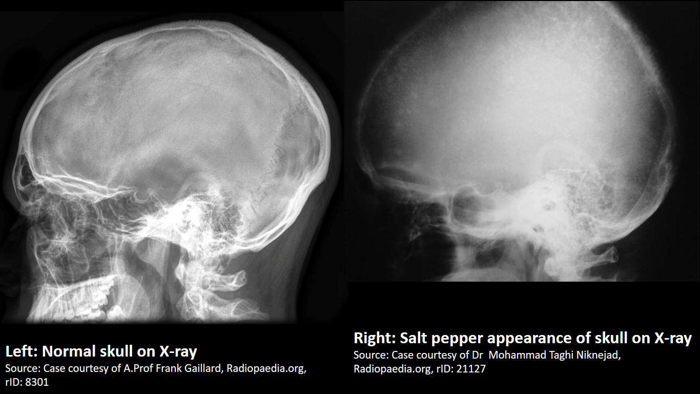 File:Salt-and-pepper-sign-skull compared to normal skull.png
