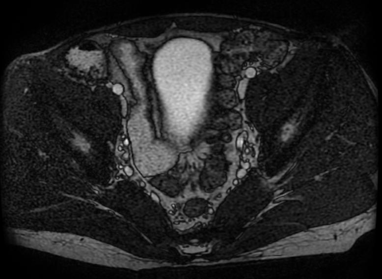 Active Crohn's disease MRI