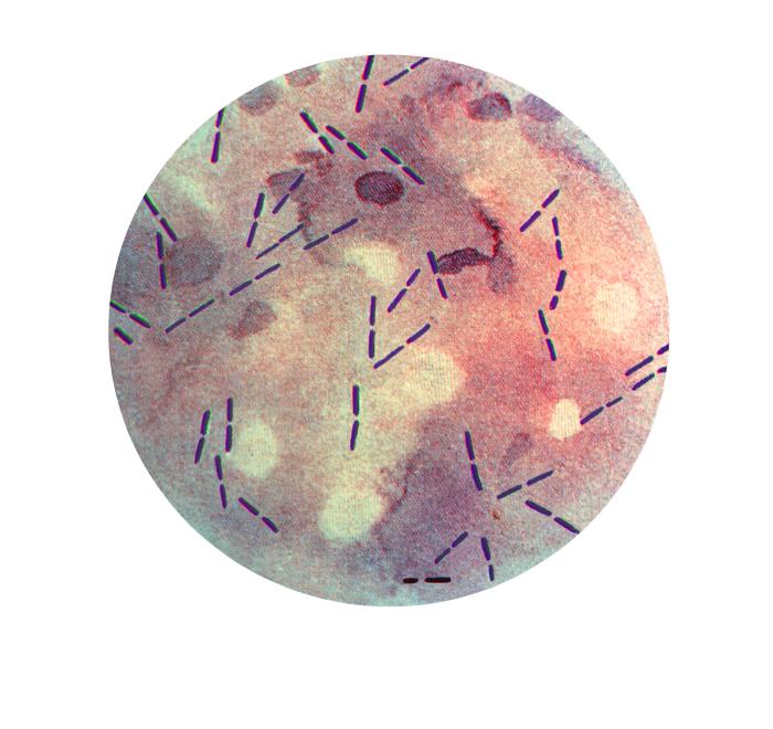 Photomicrographic view of a Gram-stained culture specimen from a patient with gas gangrene, and reveals presence of numerous Clostridium perfringens Gram-positive bacteria. From Public Health Image Library (PHIL). [5]