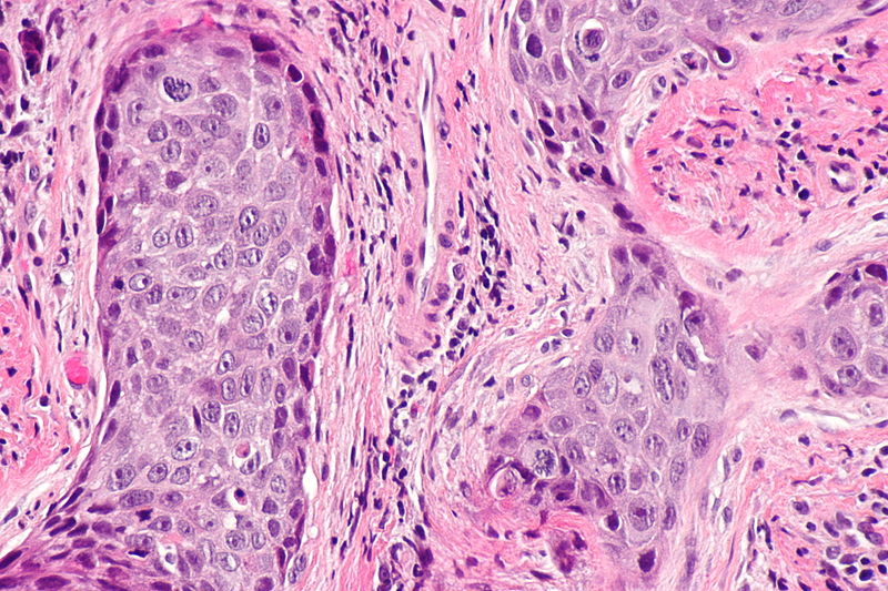 Laryngeal squamous carcinoma (High Magnification)<ref=aaa> Head and neck SCC Librepathology. http://librepathology.org/wiki/index.php/Squamous_cell_carcinoma_of_the_head_and_neck Accessed on October 26, 2015</ref>
