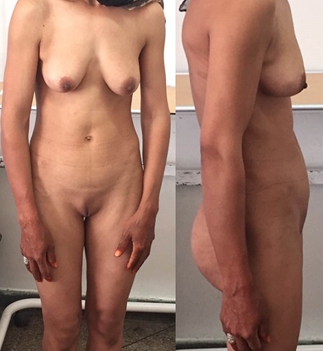 File:AIS - Front and side view of the patient.jpg