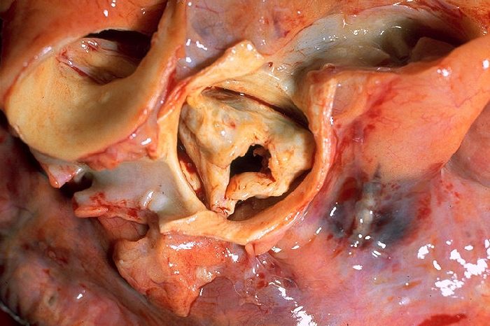 Aortic stenosis.