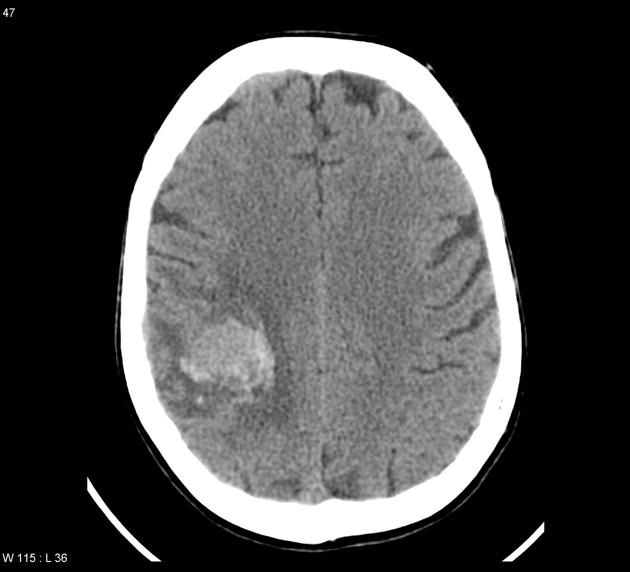 File:CT scan of brain metastasis 1.jpg
