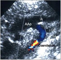 Echocardiogram showing coarctation of aorta.