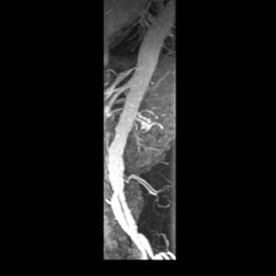 File:Renal artery stenosis 017.jpg