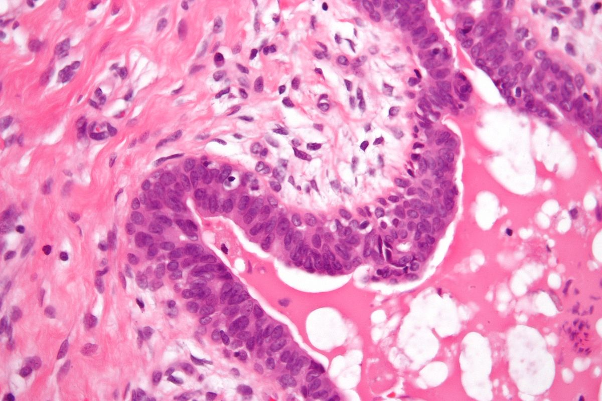 File:1200px-Gynecomastoid hyperplasia - very high mag.jpg