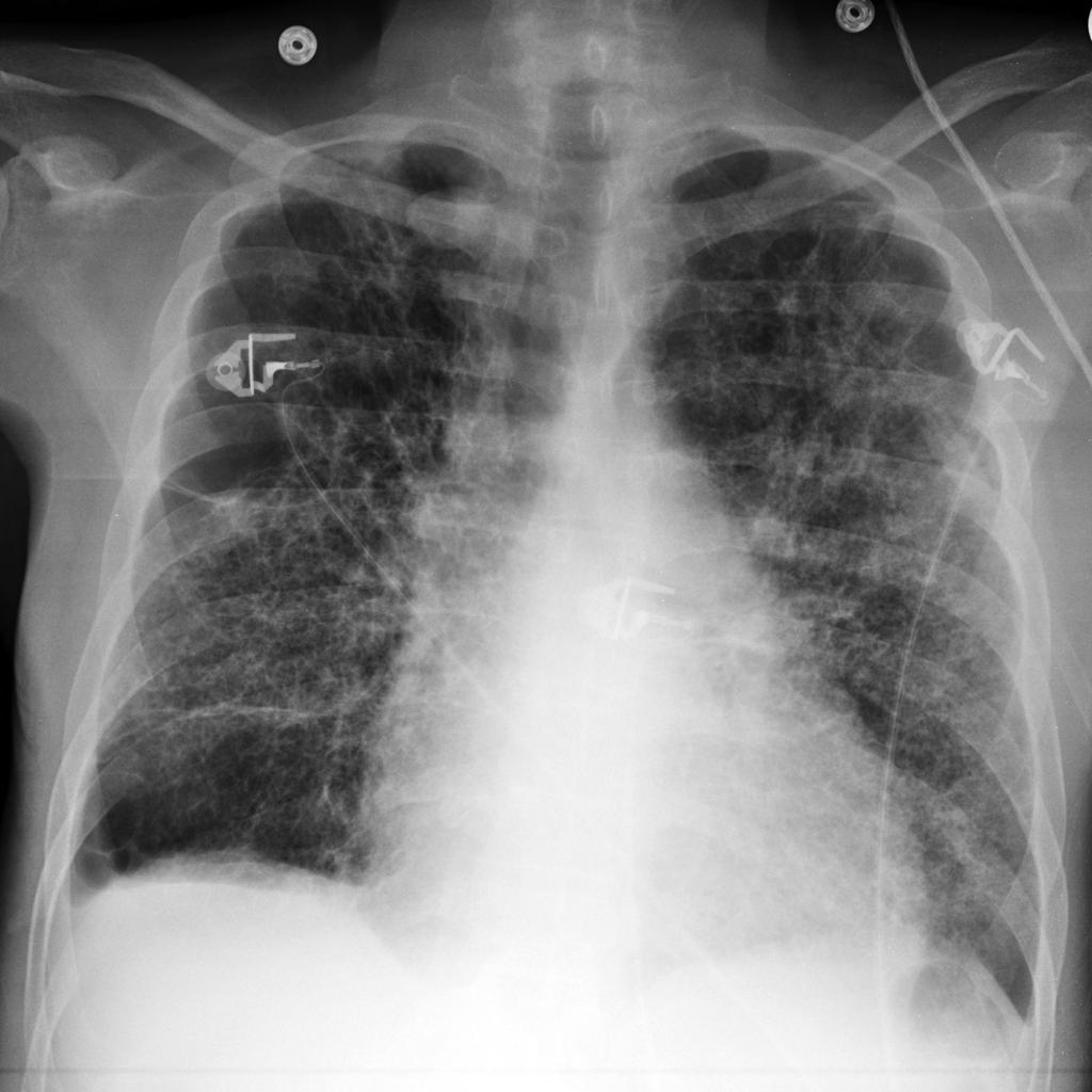 Chest X-ray of a patient demonstrates a rounded opacity located at the medial aspect of the right lung apex