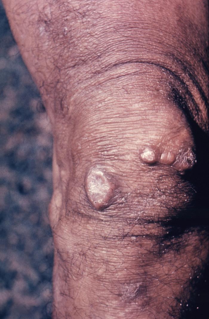 Patient’s right knee revealed the keloidal scarring brought on due to a case of cutaneous blastomycosis, which was caused by Blastomyces dermatitidis. From Public Health Image Library (PHIL). [2]