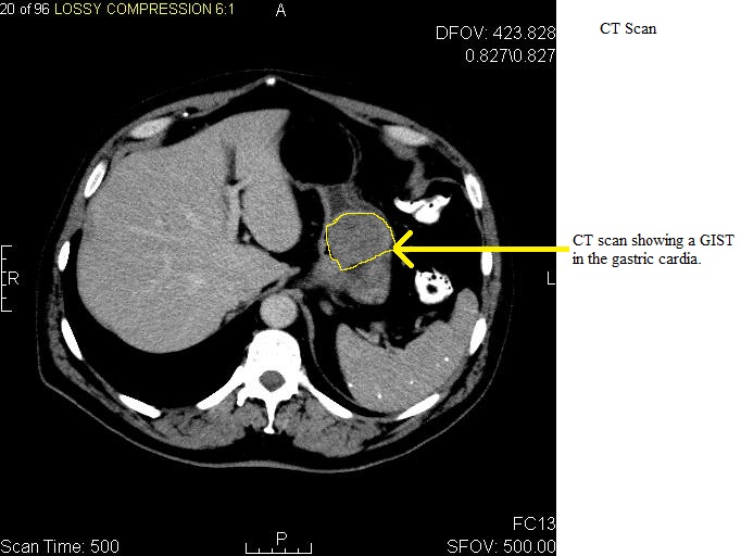 File:CT image of a GIST tumor in the gastric cardia.jpg
