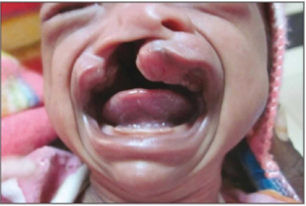 https://openi.nlm.nih.gov/detailedresult?img=PMC3354781_CCD-3-115-g001&query=cleft%20lip%20and%20palate&it=xg&req=4&npos=16%7C Cleft lip and cleft palate