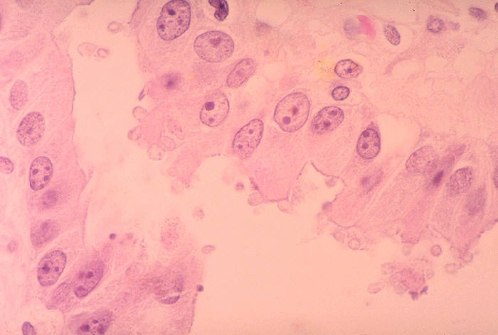 Histopathology of cryptosporidiosis, gallbladder. From Public Health Image Library (PHIL). [1]