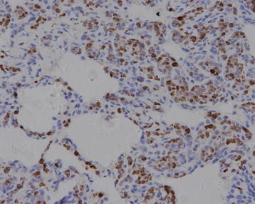 File:Intravascular large B-cell lymphoma pathology image 9.jpg