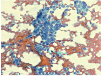 Lymph node FNA showing metastatic follicular carcinoma.[2]