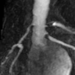File:Renal artery stenosis 026.jpg