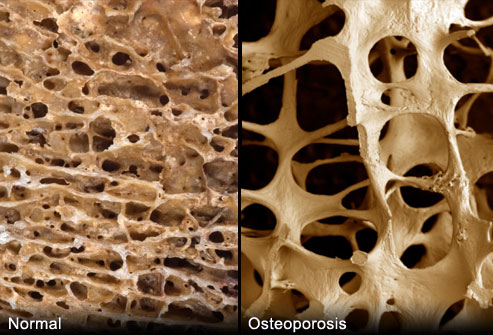 File:Webmd rm photo of porous bones.jpg