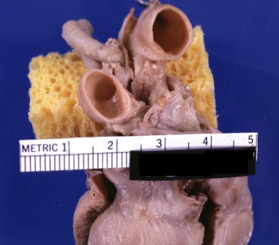Patent Ductus Arteriosus with Aneurysmal Dilation: Gross fixed tissue aorta and ductus have been cross sectioned showing arch of aorta and huge ductus in a 5 day old infant