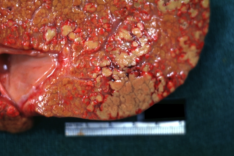 Endstage cirrhosis with lobular necrosis: Gross, natural color, very close-up view (an excellent example of alcoholic cirrhosis)