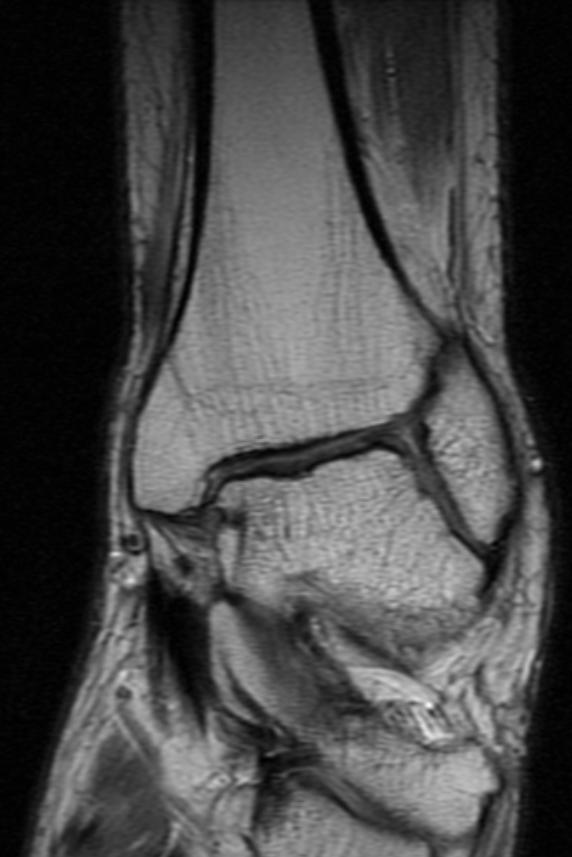 Ankle MRI in a patient with Hemophilia