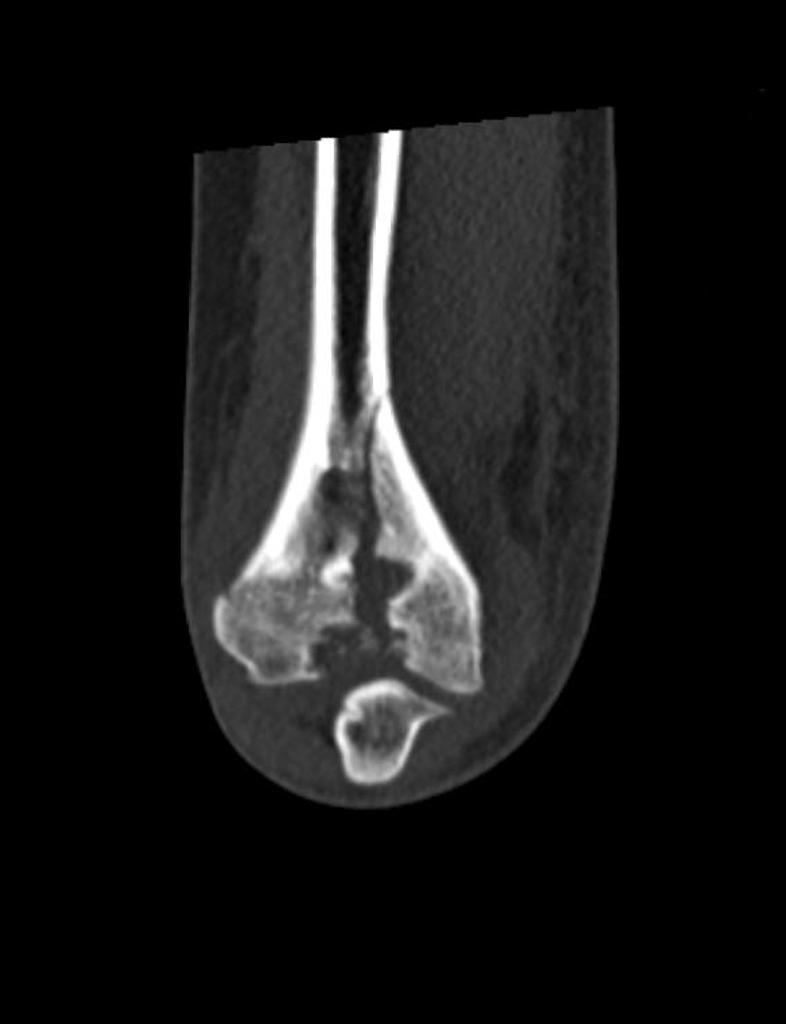 Displaced intercondylar fracture extending from the medial distal metaphysis into the trochlea with an intra-articular gap of 3 mm showing tiny interposed bone fragments.