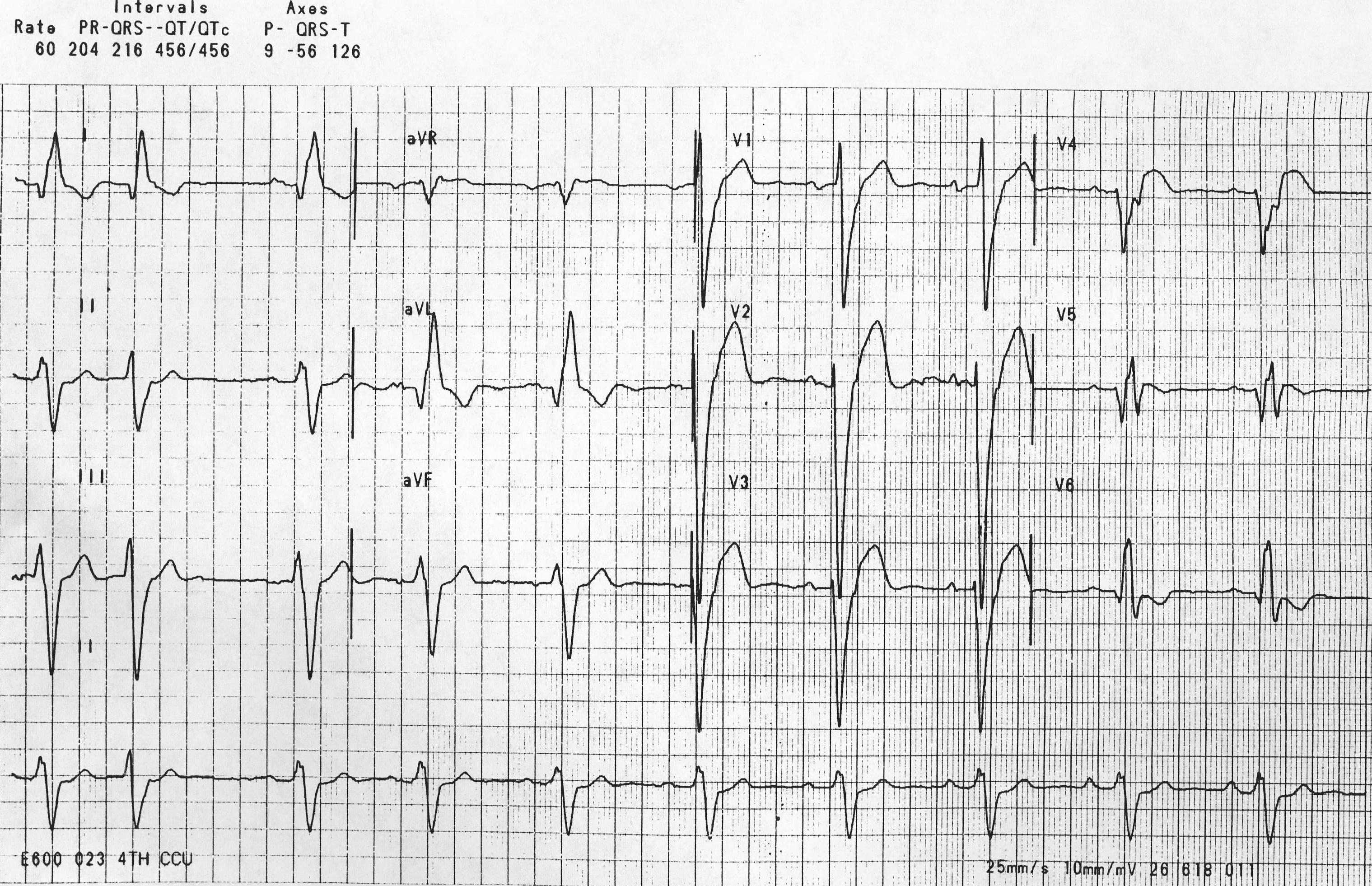 LBBB with Lateral Q waves Image courtesy of C. Michael Gibson MS MD and Copylefted