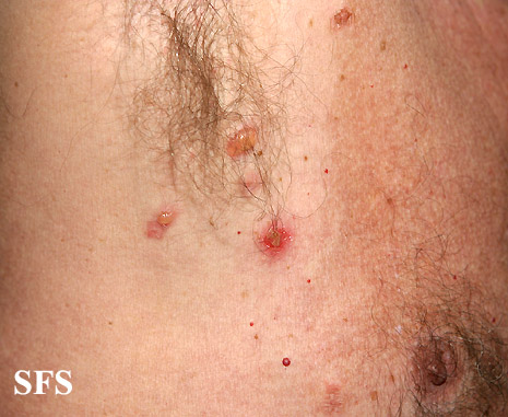 Pemphigus vulgaris. Adapted from Dermatology Atlas.[3]