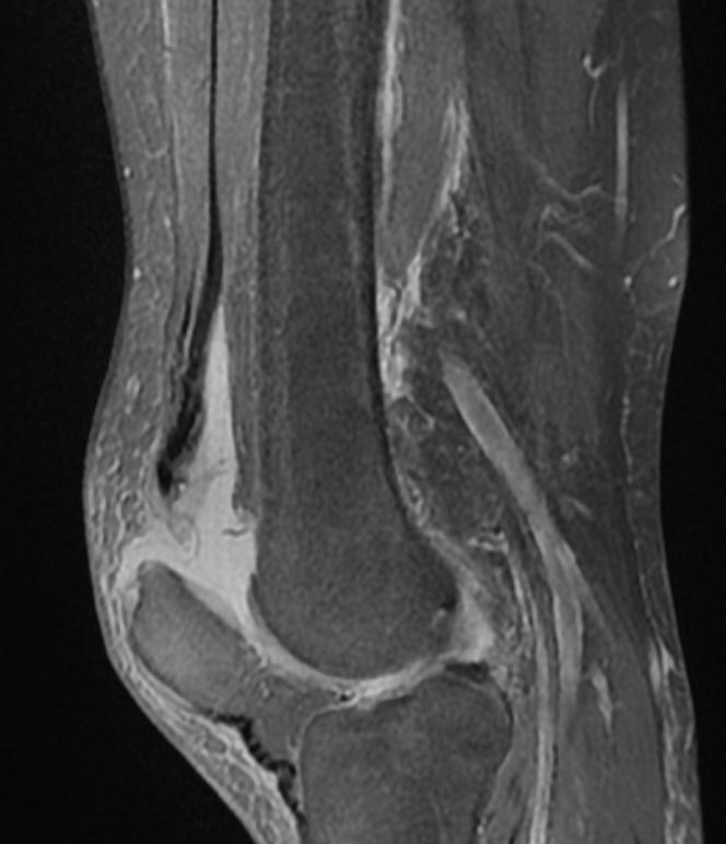 File:Quadriceps tendon rupture 003.jpg