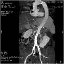 File:Renal artery stenosis 047.jpg