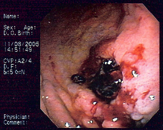 Gastric MALT lymphoma 2.jpg