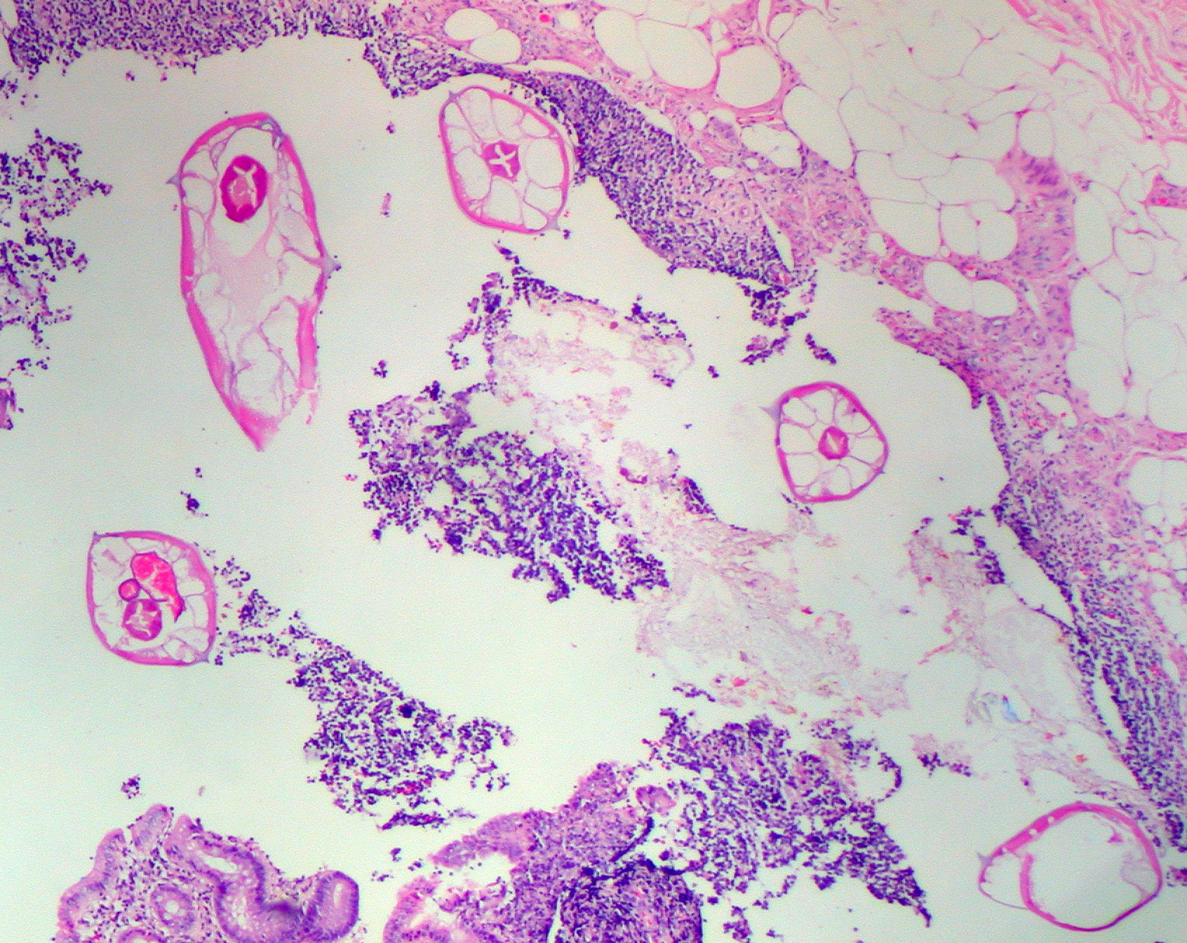 Pinworms are sometimes diagnosed incidentally by pathology. Micrograph of pinworms in the appendix. H&E stain.
