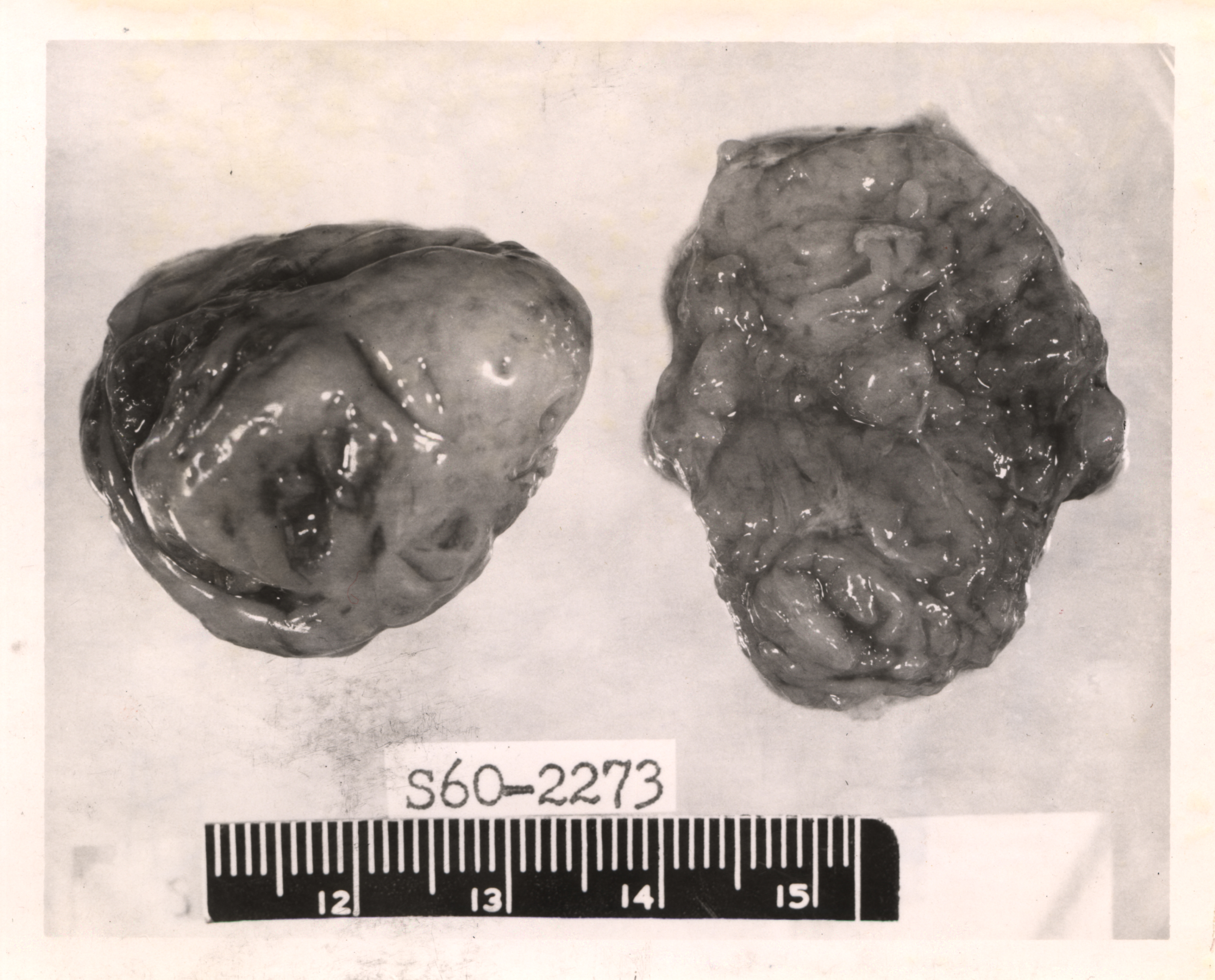 File:Tonsils used to study Tangier's disease.jpg