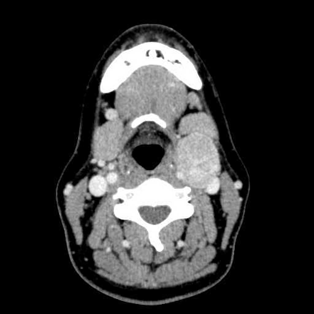 File:Carotid-body-tumour-CT.jpg