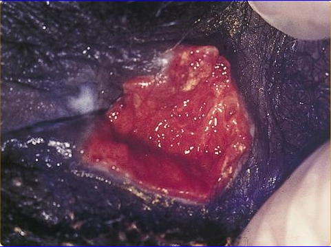 Genital ulcer in a female patient with Donovanosis.