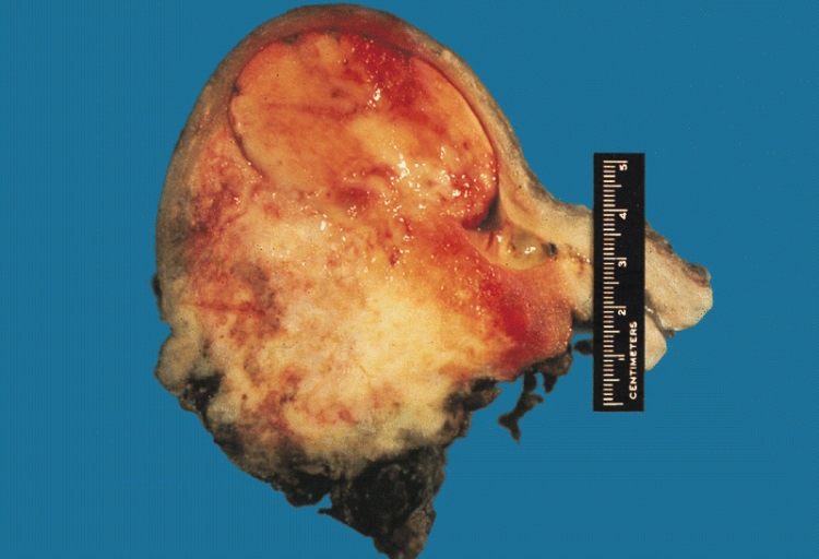 Malignant mixed müllerian tumor
