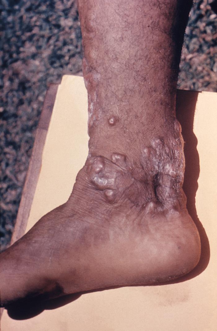 Patient’s right ankle displayed keloidal scarring brought on due to a case of cutaneous blastomycosis, caused by Blastomyces dermatitidis. From Public Health Image Library (PHIL). [3]