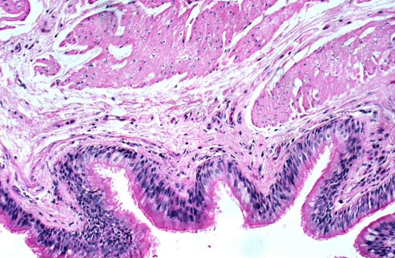 Lower Respiratory Tract: Bronchogenic cyst; There is a cyst lined by bronchiolar epithelium and thick fascicles of smooth muscle in the wall. Islands of cartilage and submucosal salivary glands are lacking and the designation "foregut cyst consistent with bronchogenic cyst" might be more appropriate.