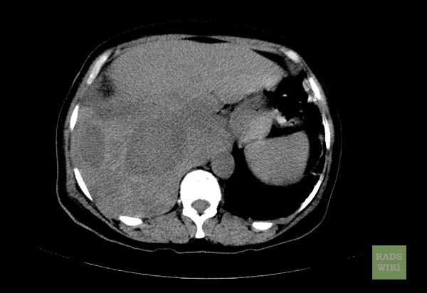 File:Fibrous-tumor-pleura-006.jpg