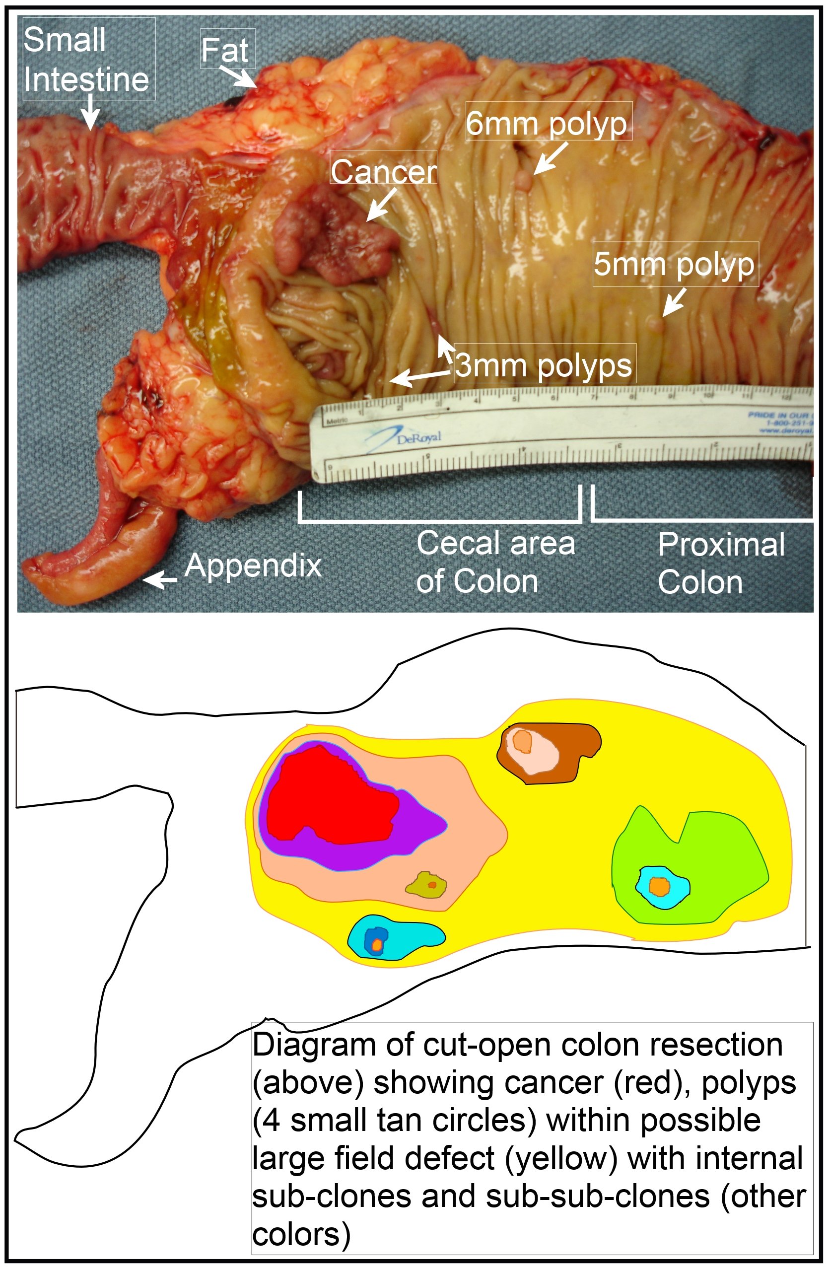 File:Image of resected colon segment with cancer & 4 nearby polyps plus schematic of field defects with sub-clones.jpg