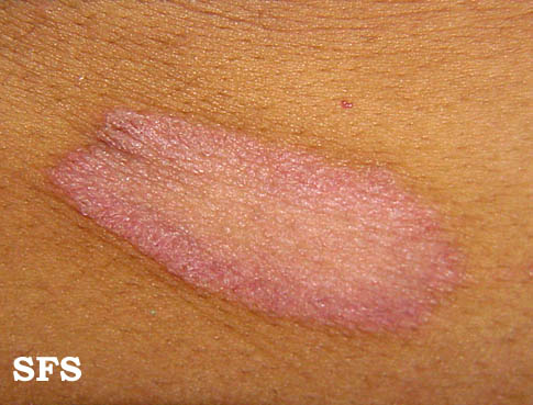 Pityriasis rosea. Adapted from Dermatology Atlas.[1]