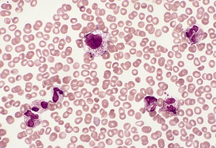 A blood smear from a young woman with mast cell leukemia and marked eosinophilia. There are five eosinophils, one neutrophil, and a large atypical-appearing mast cell with relatively sparse small granules and a slightly lobulated nucleus. This patient had eosinophilia as a presenting feature and was initially thought to have a hypereosinophilic syndrome. Eosinophilia is observed in approximately one third of patients with systemic mast cell disease. (Wright-Giemsa stain)