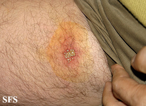 File:Herpes simplex 27.jpeg