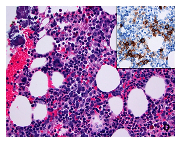 Retrospective evaluation of the bone marrow also showed inconspicuous large cells in clusters highlighted with CD20 (inset).[1]