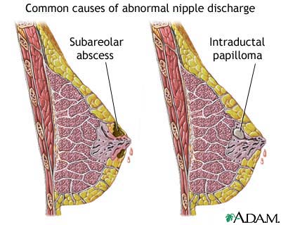 Nipple discharge.jpg
