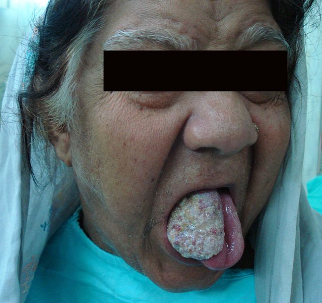 A large squamous cell carcinoma of the tongue[8]