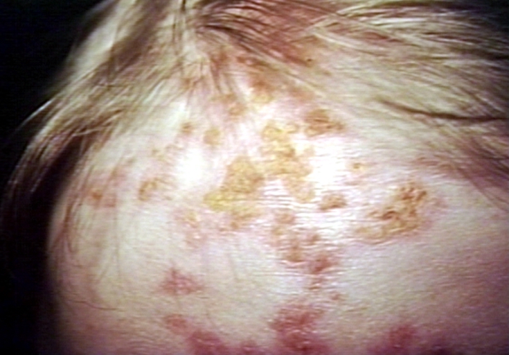 Skin: alopecia, secondary lupus erythematosus; hair loss. Image courtesy of Professor Peter Anderson DVM PhD and published with permission © PEIR, University of Alabama at Birmingham, Department of Pathology.[1]