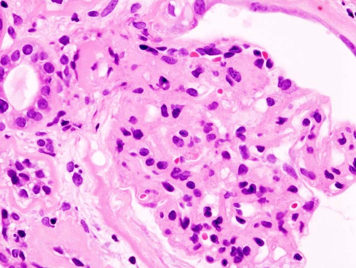 Histopathological image of diabetic glomerulosclerosis with nephrotic syndrome. H&E stain.