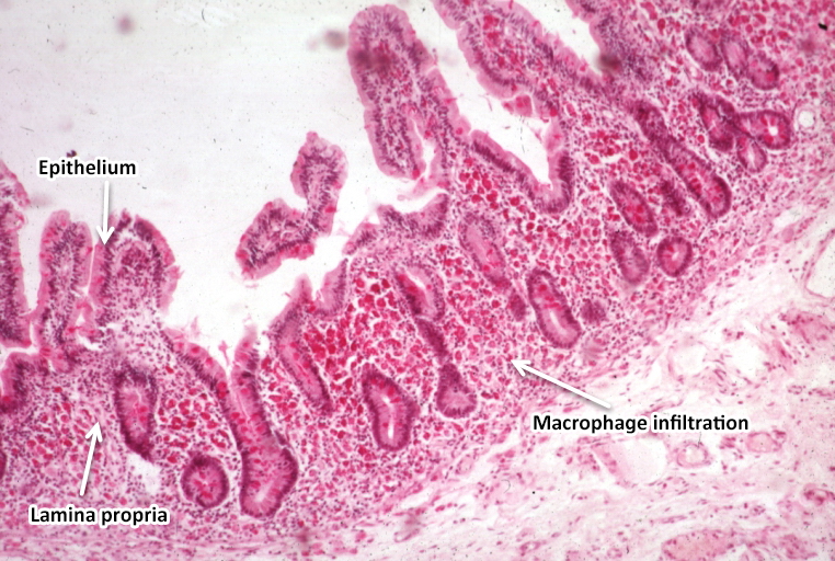 File:Light microscopy of intestine-Whipples Disease.jpg .jpg