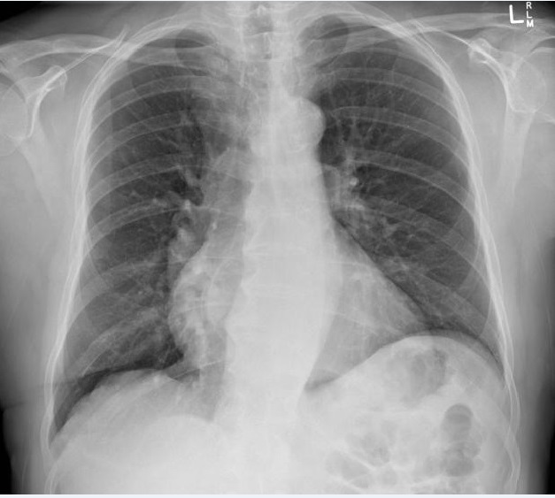 File:M.S chest X-ray.jpg