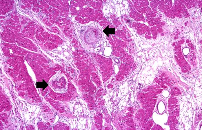 This is a higher-power photomicrograph of the affected vessels in the heart (arrows). There are areas of fibrosis (old infarcts) in the myocardium adjacent to these affected vessels.
